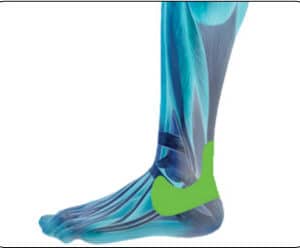 Kipulaastari lääkkeetön Fit nilkkakipuun